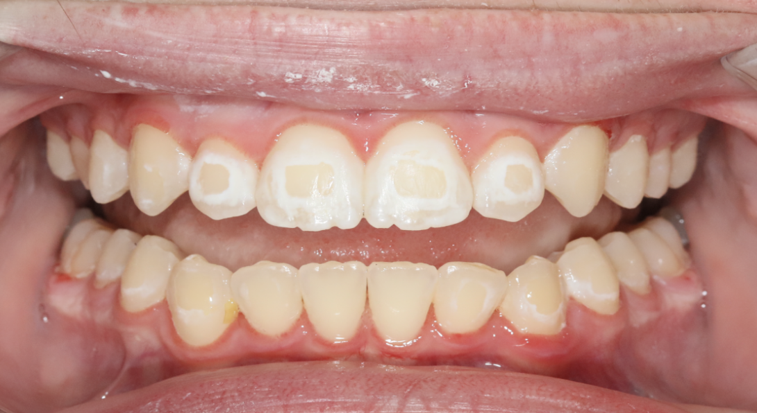 tipping molar illustration